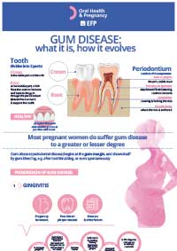 Gum disease - what it is, how it evolves
